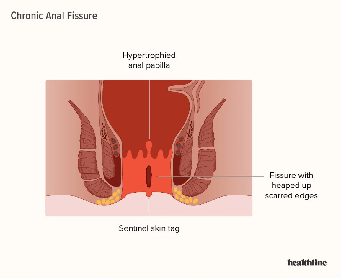 anal pain homemade