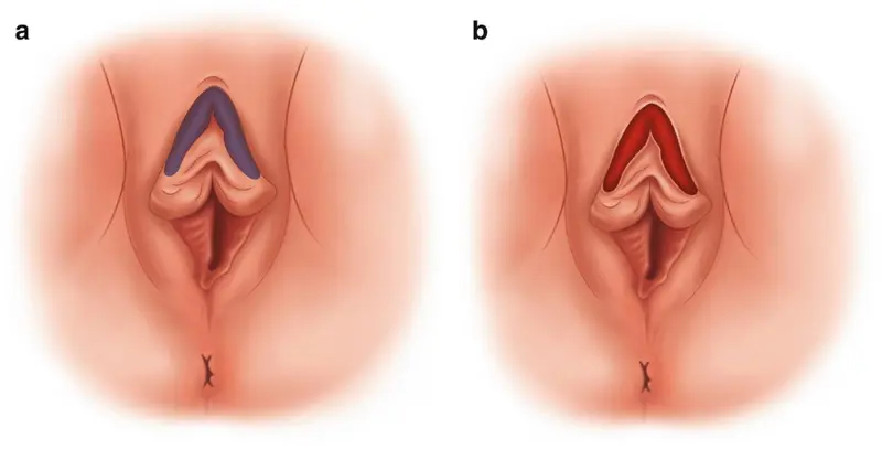 diane monbleau recommends clit hood pulled back pic