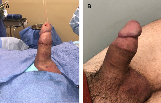 dana dayan recommends Penile Implant Porn